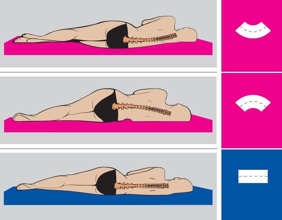 Правилна позиция на тялото по време на сън с лумбална остеохондроза
