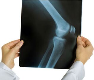 Рентгенова снимка на артроза на колянната става